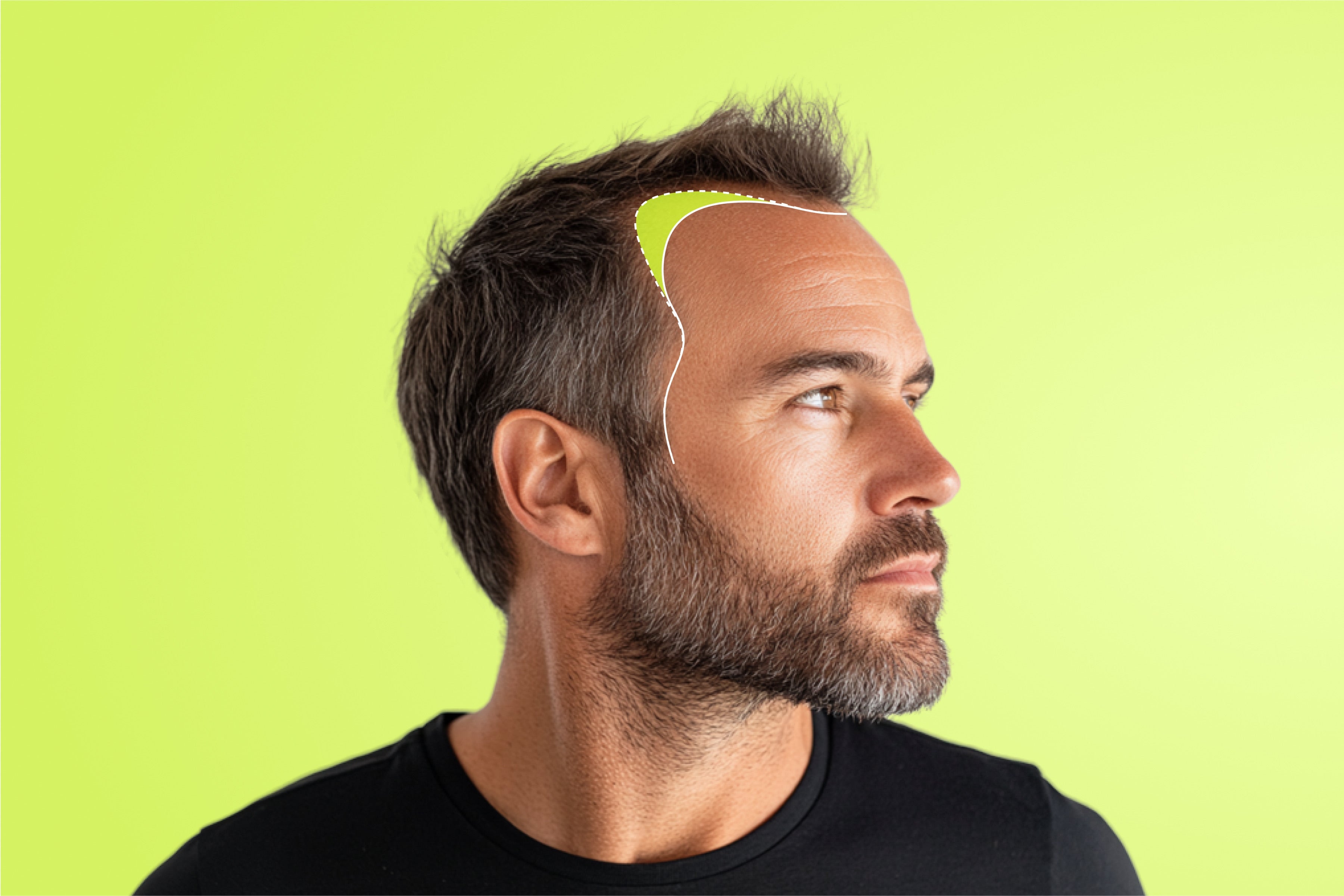 Receding hairlines and their solutions