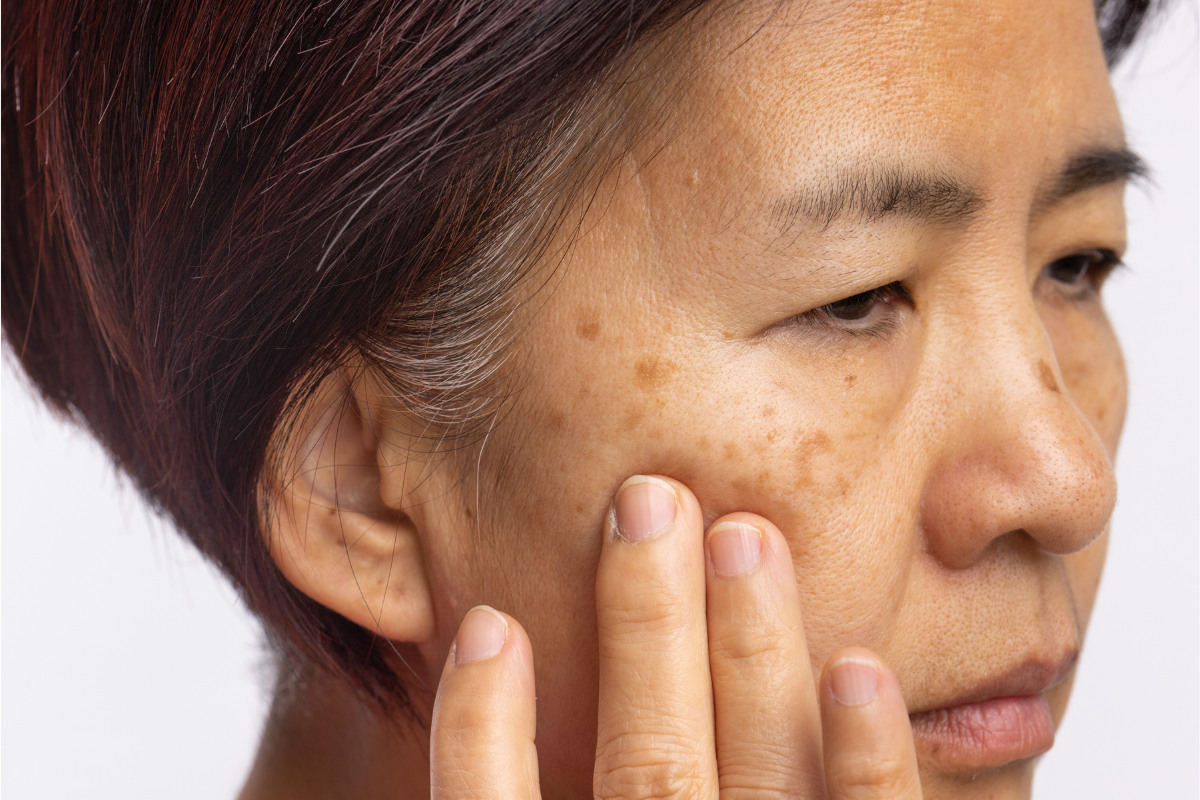 Will Hyperpigmentation Fade? What Causes Dark Spots and How Skin Recovers
