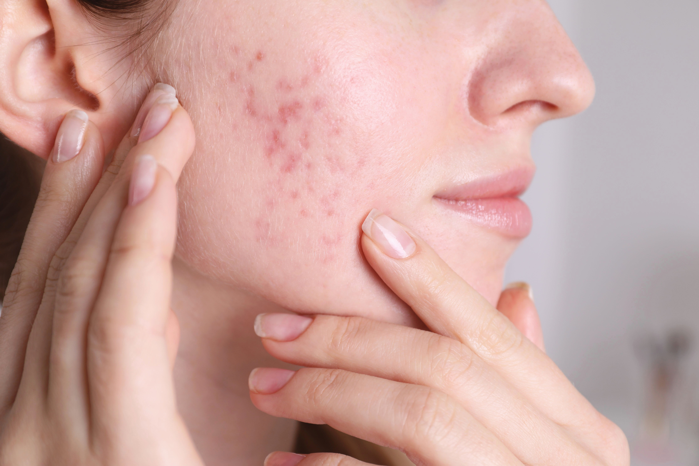 Post-Acne Marks and Scars: Science-Backed Strategies to Support Skin Repair