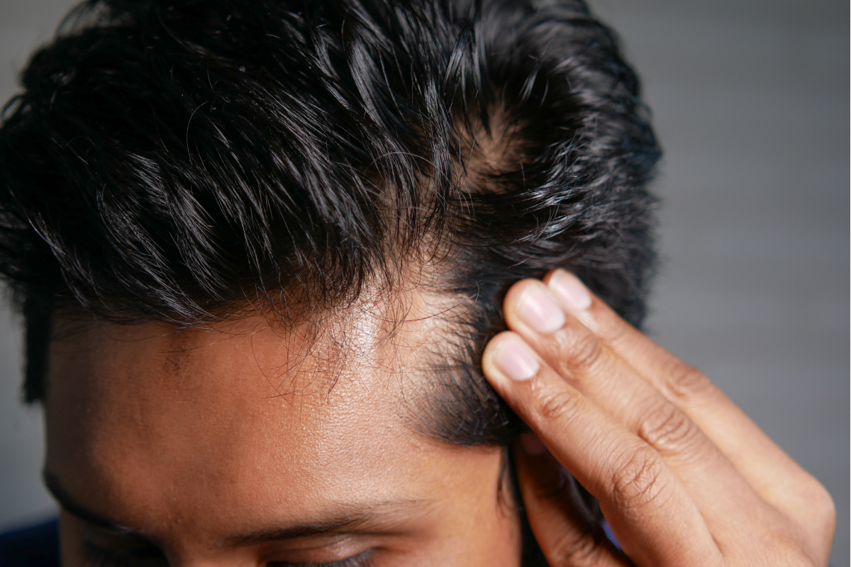 First Signs of Hair Thinning You Might Be Overlooking